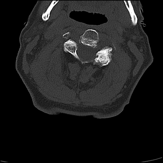 File:Atlas (type 3b subtype 1) and axis (Anderson and D'Alonzo type 3, Roy-Camille type 2) fractures (Radiopaedia 88043-104607 Axial bone window 28).jpg