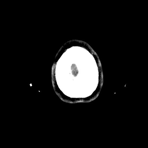 Atretic cephalocele (Radiopaedia 89782-106881 Axial non-contrast 183).jpg