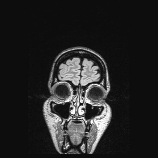 Atretic encephalocoele with inferior vermis hypoplasia (Radiopaedia 30443-31108 Coronal FLAIR 163).jpg