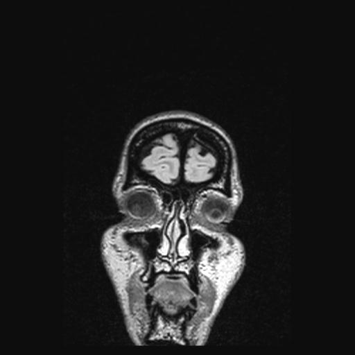 Atretic encephalocoele with inferior vermis hypoplasia (Radiopaedia 30443-31108 Coronal FLAIR 168).jpg