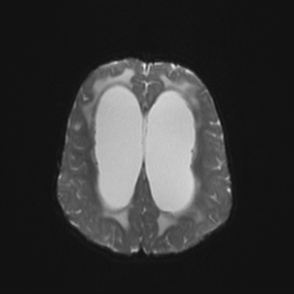Atypical medulloblastoma (Radiopaedia 34903-36371 Axial DWI 21).jpg