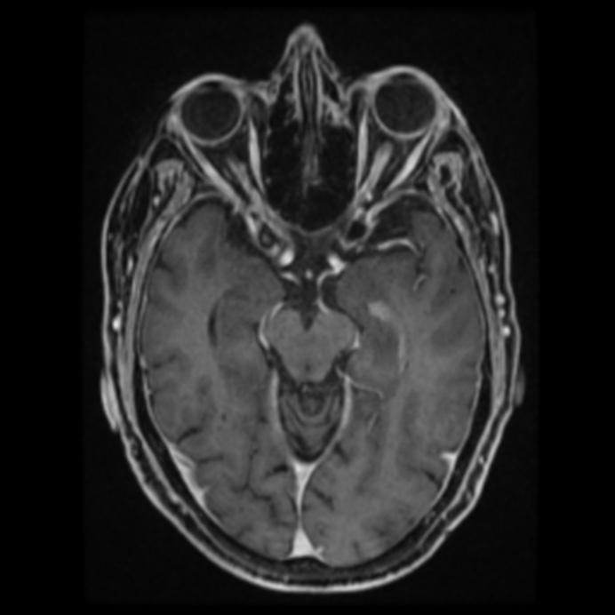 Atypical meningioma (Radiopaedia 45535-49629 Axial T1 C+ 32).jpg