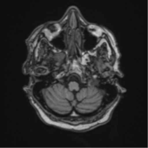 Atypical meningioma (WHO Grade II) (Radiopaedia 54742-60981 Axial T1 11).png
