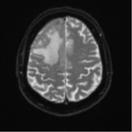 File:Atypical meningioma (WHO grade II) with brain invasion (Radiopaedia 57767-64729 Axial DWI 23).png