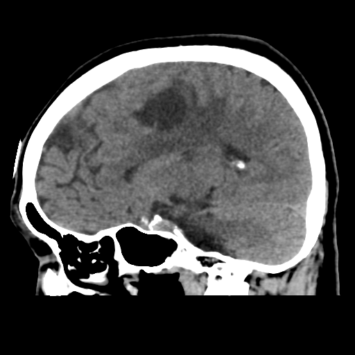 File:Atypical meningioma with skull invasion (Radiopaedia 34357-35649 E 23).png