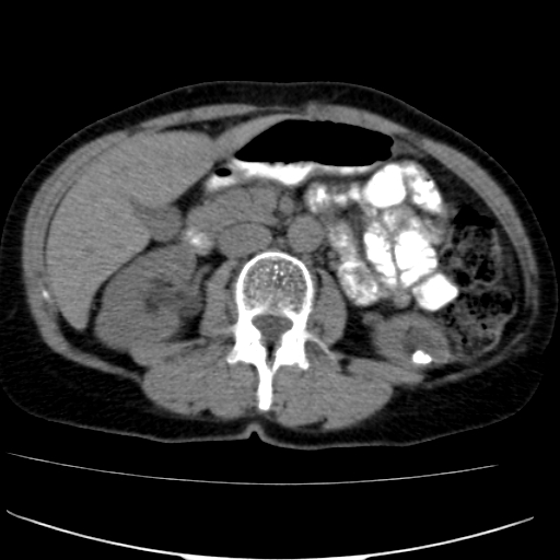 File:Atypical renal cyst (Radiopaedia 17536-17251 non-contrast 18).jpg