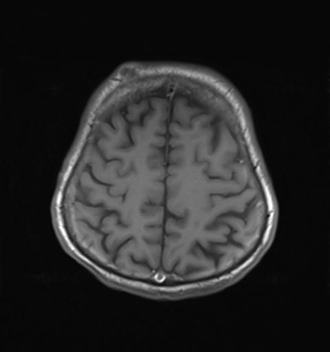 File:Autoimmune limbic encephalitis (Radiopaedia 30363-31005 Axial T1 26).jpg