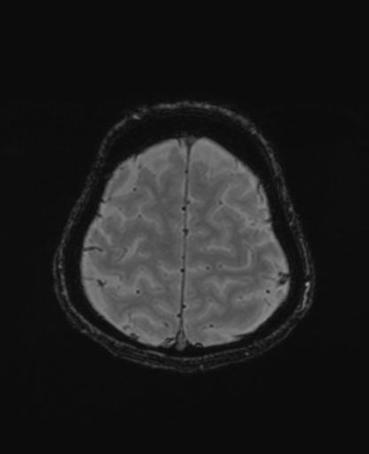 Autoimmune limbic encephalitis (Radiopaedia 30363-31005 SWI - magnitude 68).jpg
