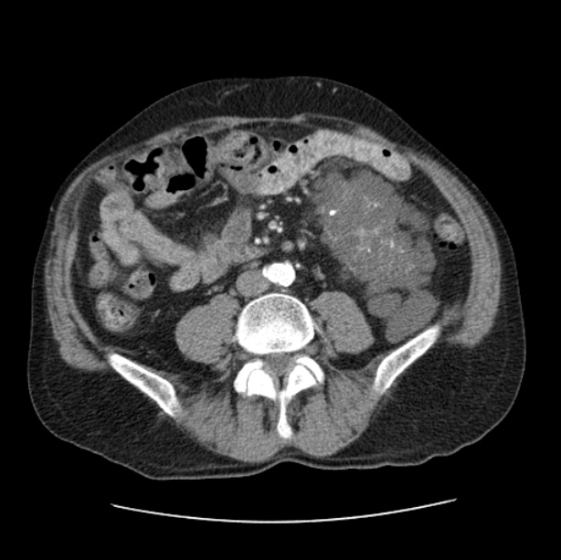 Autosomal dominant polycystic kidney disease (Radiopaedia 27851-28094 B 84).jpg