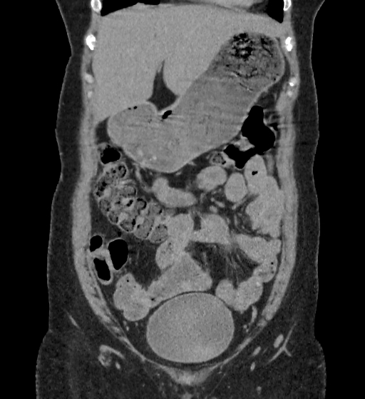 Autosomal dominant polycystic kidney disease (Radiopaedia 38189-40194 Coronal C+ delayed 13).jpg