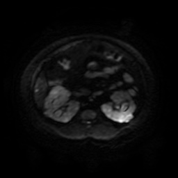 File:Autosomal dominant polycystic kidney disease (Radiopaedia 50259-55611 Axial DWI 58).jpg