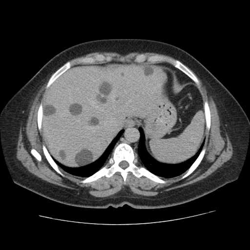Autosomal dominant polycystic kidney disease with hepatic involvement (Radiopaedia 32693-33662 C 10).jpg