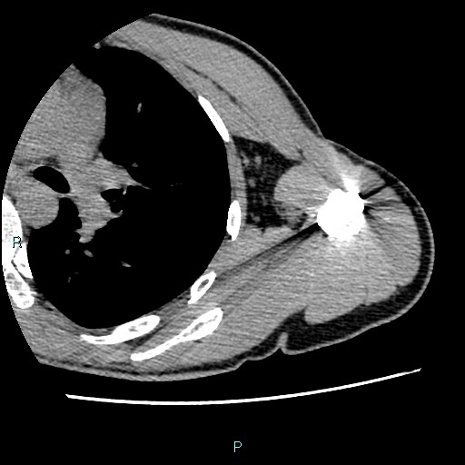 Avascular necrosis after fracture dislocations of the proximal humerus (Radiopaedia 88078-104655 D 80).jpg