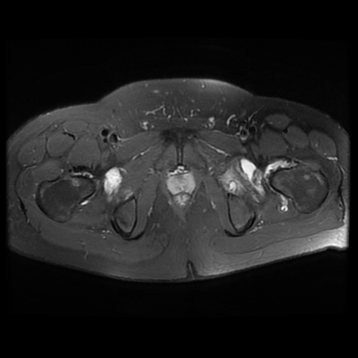 File:Avascular necrosis of the hip (Radiopaedia 61503-69465 Axial PD fat sat 22).jpg