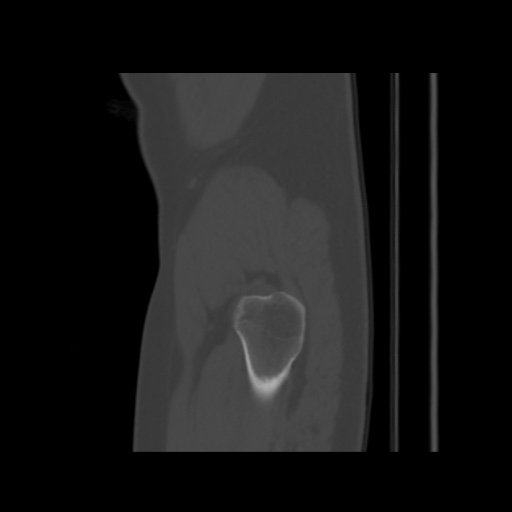 File:Avascular necrosis of the hip (Radiopaedia 61503-69467 B 58).jpg