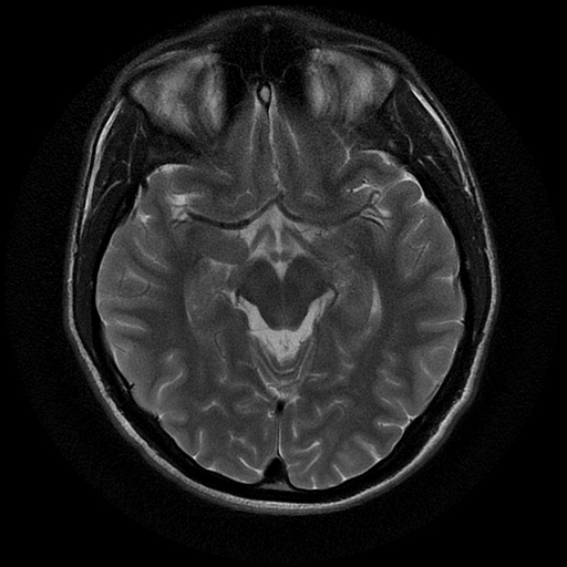 File:Azygos anterior cerebral artery (Radiopaedia 17059-16756 Axial T2 15).jpg