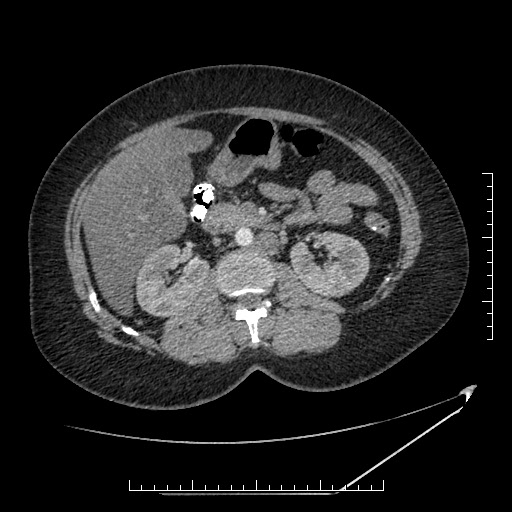 File:Azygos continuation of the IVC (Radiopaedia 40416-42965 A 36).jpg