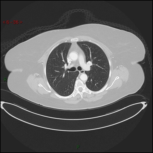 Azygos fissure and lobe (Radiopaedia 47620-52278 Axial lung window 36).jpg