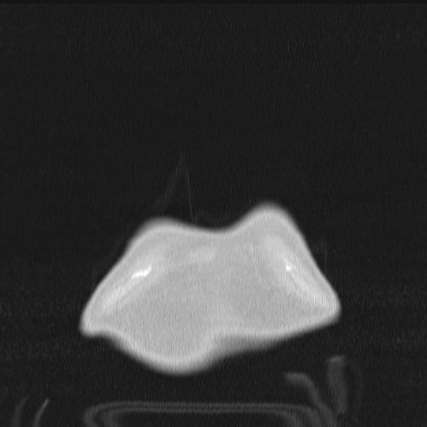 Azygos lobe (Radiopaedia 38259-40275 Coronal lung window 2).jpg
