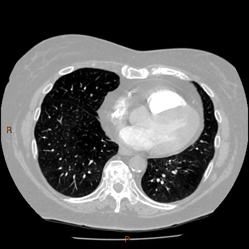 Azygos lobe (Radiopaedia 40161-42821 Axial lung window 49).jpg