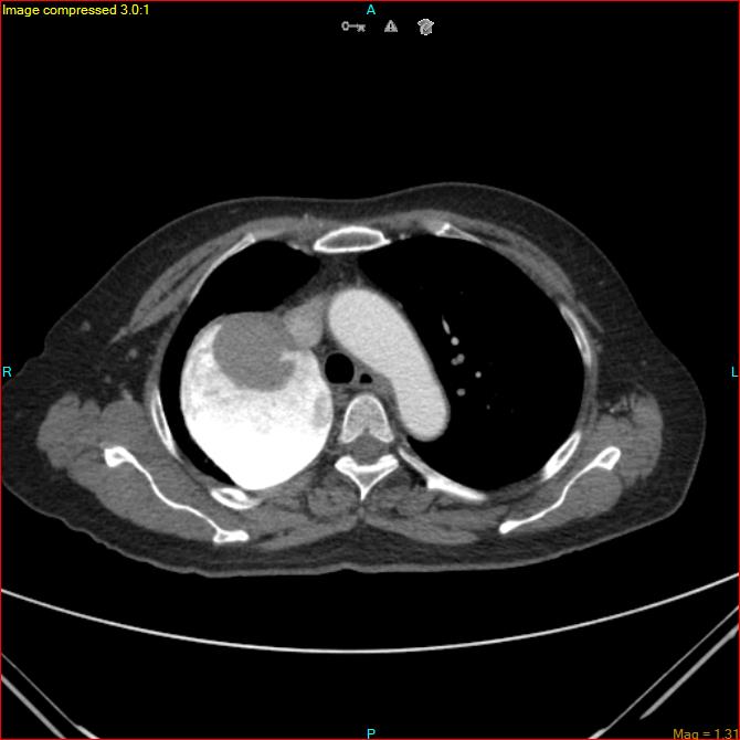 Azygos vein aneurysm (Radiopaedia 77824-90130 B 20).jpg