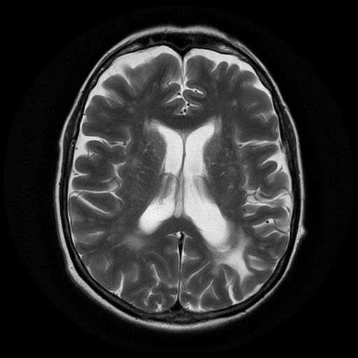 File:Balo concentric sclerosis (Radiopaedia 53875-59982 Axial T2 15).jpg