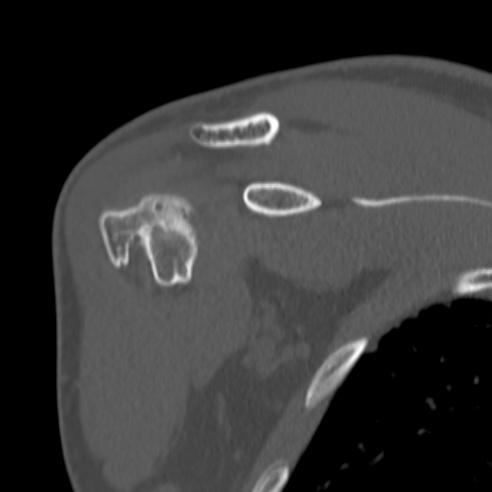 Bankart lesion (Radiopaedia 57256-64185 Coronal bone window 17).jpg