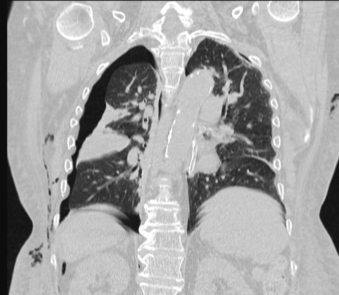 Barotrauma due to mechanical ventilation (Radiopaedia 28079-28336 Coronal lung window 63).jpg