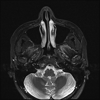 File:Basal cell carcinoma - nasal region (Radiopaedia 70292-80365 Axial STIR 14).jpg