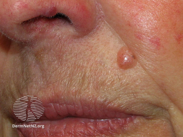 File:Basal cell carcinoma affecting the face (DermNet NZ lesions-bcc-face-0702).jpg