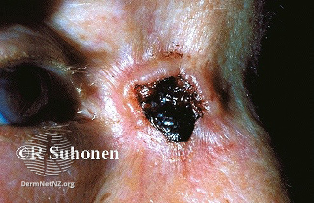 File:Basal cell carcinoma affecting the nose (DermNet NZ lesions-bcc-nose-0651).jpg