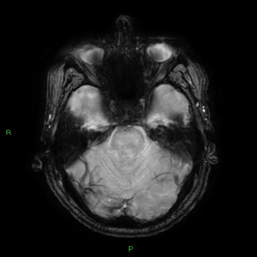 Basal ganglia hemorrhage (Radiopaedia 58346-65468 Axial SWI 22).jpg