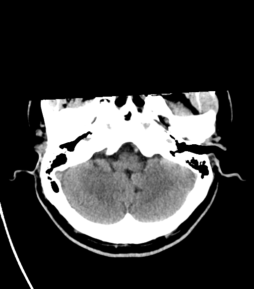 File:Basal ganglia hemorrhage - hypertensive (Radiopaedia 42227-45304 Axial non-contrast 6).png