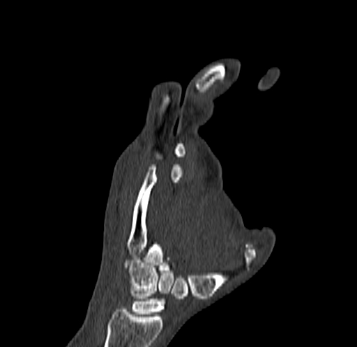Base of 2nd metacarpal fracture (Radiopaedia 73741-84544 Coronal bone window 51).jpg