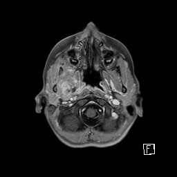 Base of skull rhabdomyosarcoma (Radiopaedia 32196-33142 T1 C+ fat sat 22).jpg