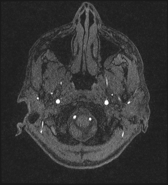 Basilar artery perforator aneurysm (Radiopaedia 82455-97733 Axial MRA 20).jpg