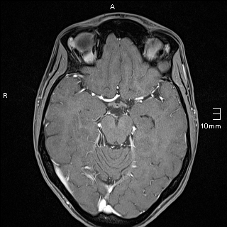 File:Basilar artery perforator aneurysm (Radiopaedia 82455-99523 G 57).jpg