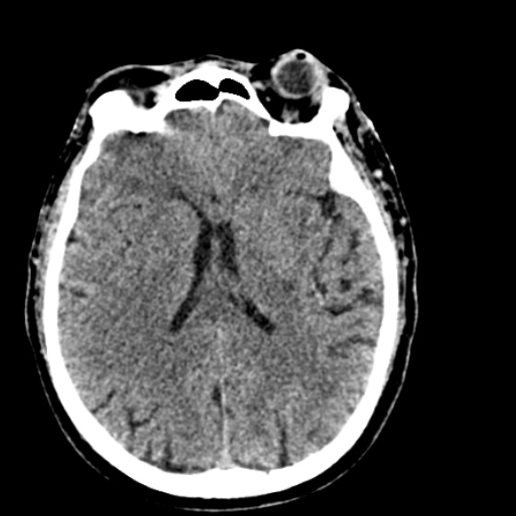 Basilar artery thrombosis (Radiopaedia 53351-59333 Axial non-contrast 72).jpg