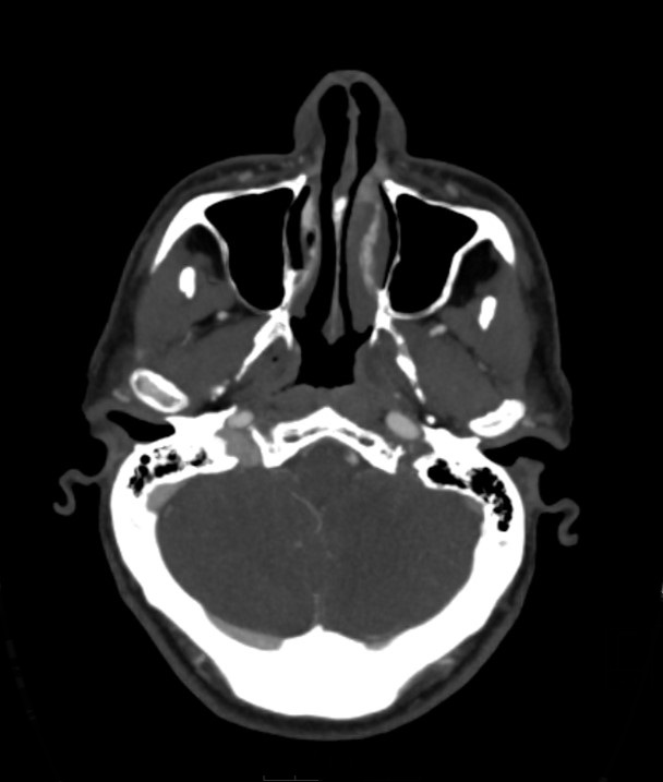 Basilar artery thrombosis and ascending transtentorial herniation (Radiopaedia 84759-100360 B 51).jpg