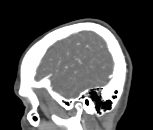 Basilar tip aneurysm with coiling (Radiopaedia 53912-60086 C 15).jpg