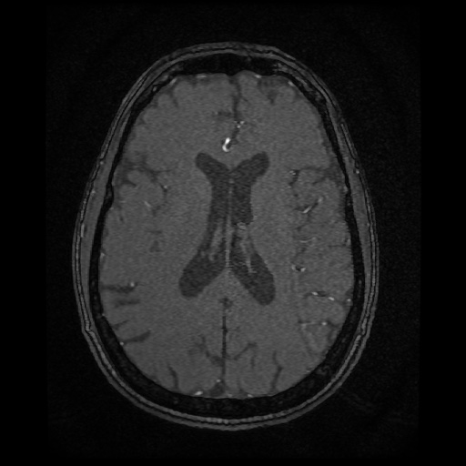 Basilar top and left middle cerebral artery aneurysm (Radiopaedia 61965-70031 Axial MRA 103).jpg