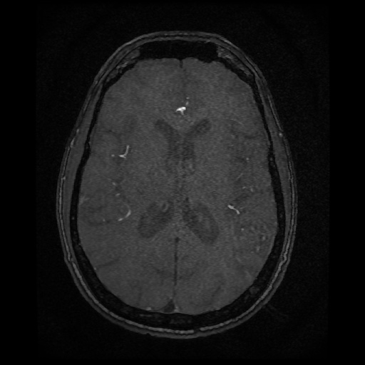 Basilar top and left middle cerebral artery aneurysm (Radiopaedia 61965-70031 Axial MRA 98).jpg