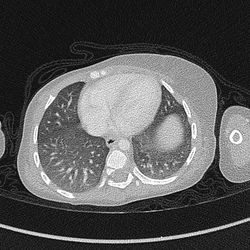 Beckwith-Wiedeman syndrome with bilateral Wilms tumors (Radiopaedia 60850-68629 Axial lung window 45).jpg
