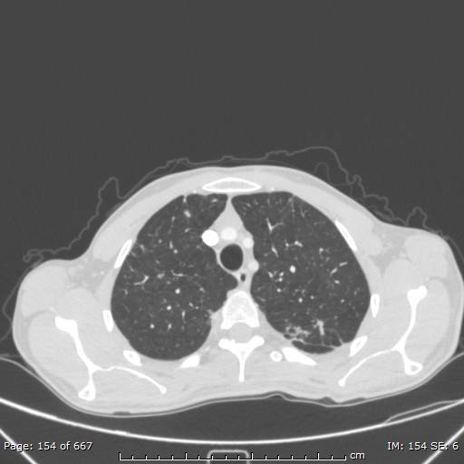 File:Behçet disease (Radiopaedia 44247-47889 Axial lung window 16).jpg