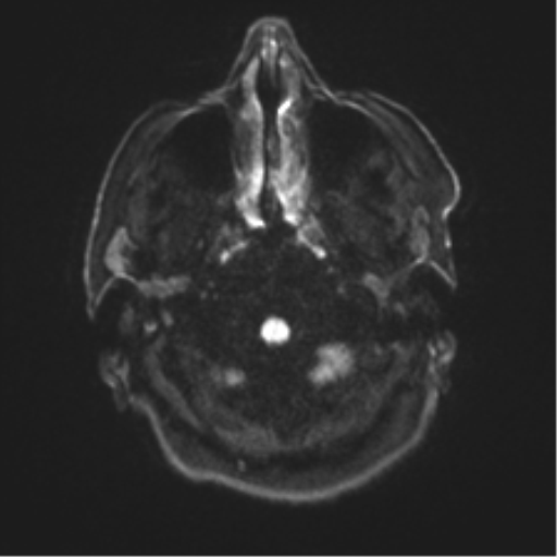 Behavioral variant frontotemporal dementia and late onset schizophrenia (Radiopaedia 52197-58083 Axial DTI Trace W 29).png