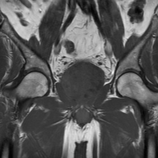 File:Benign prostatic nodular hyperplasia (Radiopaedia 16917-16634 Coronal T1 10).jpg