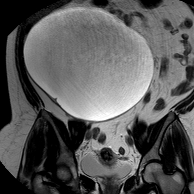 File:Benign seromucinous cystadenoma of the ovary (Radiopaedia 71065-81300 F 15).jpg