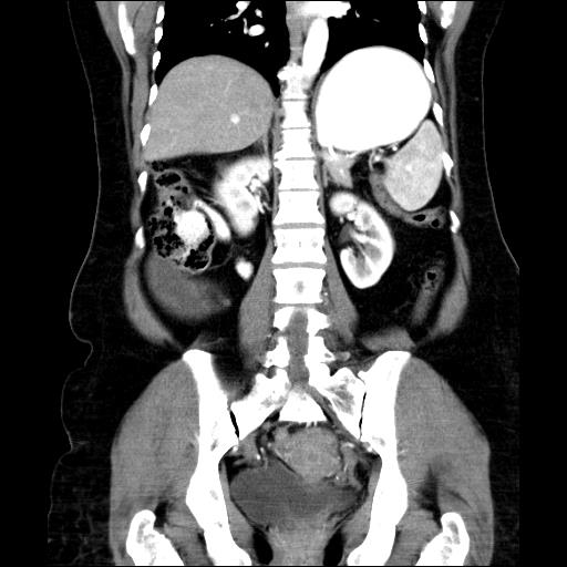 File:Benign spindle cell tumor - abdominopelvic (Radiopaedia 61300-69212 C 37).jpg