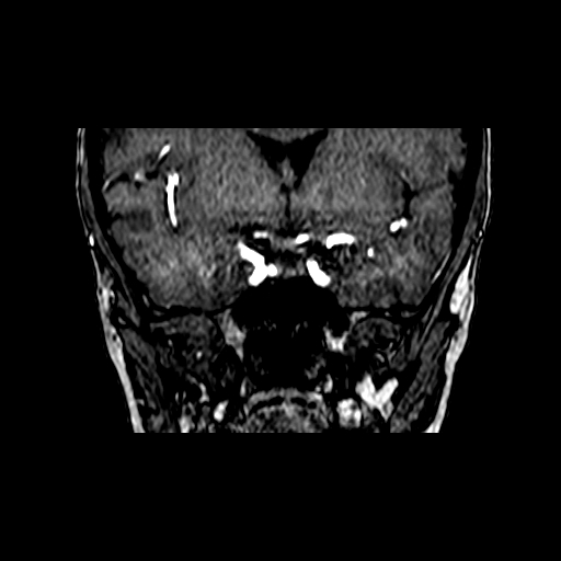 Berry aneurysm of the terminal internal carotid artery (Radiopaedia 88286-104918 Coronal TOF 36).jpg