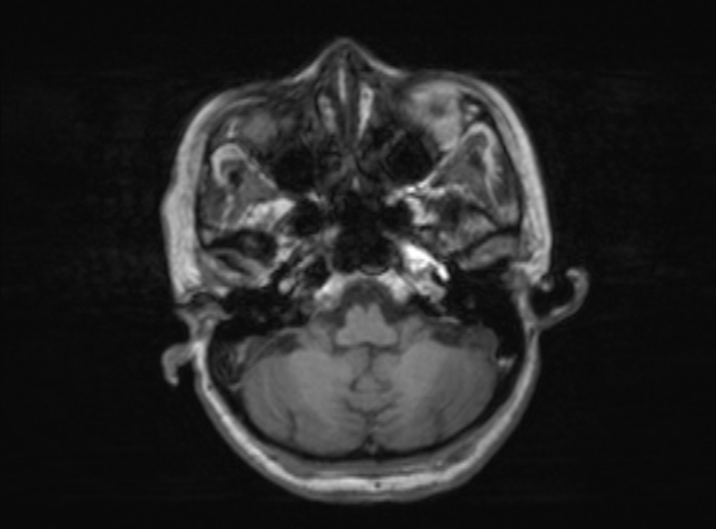 File:Bilateral PCA territory infarction - different ages (Radiopaedia 46200-51784 Axial T1 316).jpg